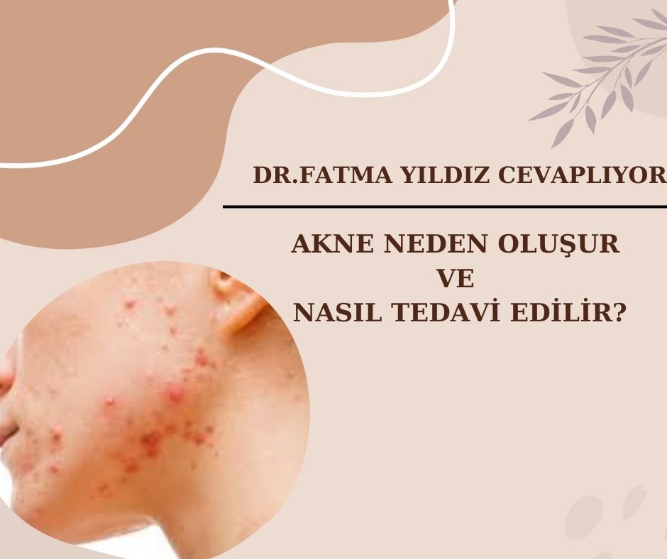 Akne/ Neden/ Oluşur/ ve Nasıl/ Tedavi/ Edilir?