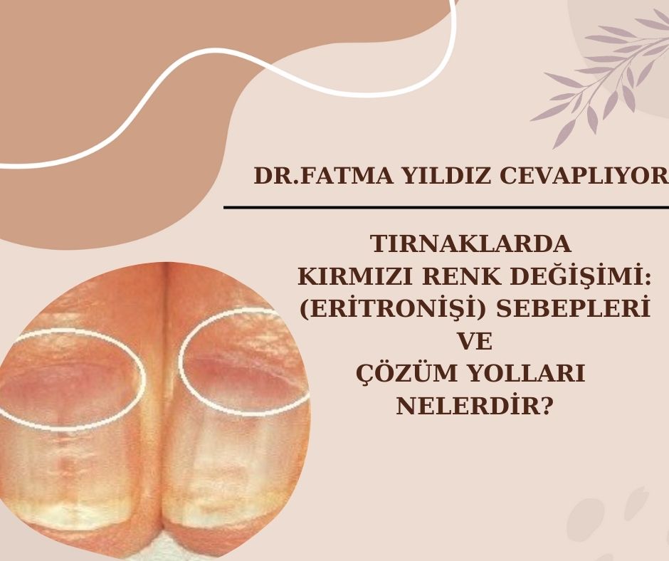 Tırnaklarda/ Kırmızı/ Renk/ Değişimi/ Eritronişi/Sebepleri/ ve /Çözüm Yolları/ Nelerdir? 