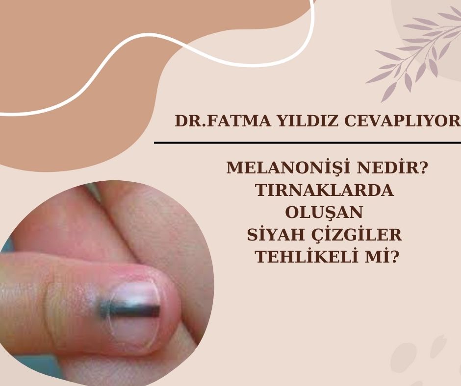 Melonişi/ Nedir/ Tırnaklarda/ Oluşan/ Siyah Çizgiler /Tehlikeli Mi?