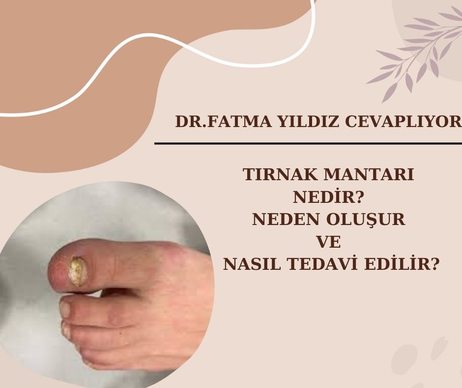 Tırnak Mantarı/ Nedir? Neden oluşur/ ve Nasıl/ Tedavi Edilir?