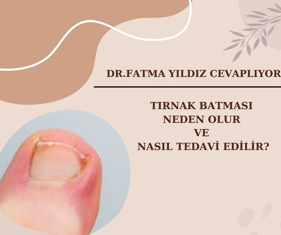Tırnak Batması/ Neden Olur/ ve Nasıl/ Tedavi Edilir?