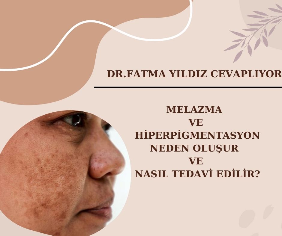 Melazma/ ve Hiperpigmentasyon /Neden Oluşur/ ve Nasıl/ Tedavi Edilir?