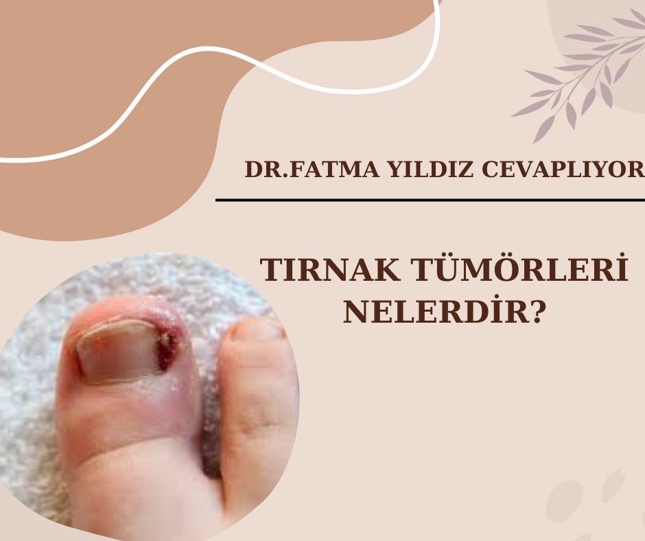 Tırnak/ Tümörleri/ Nelerdir?