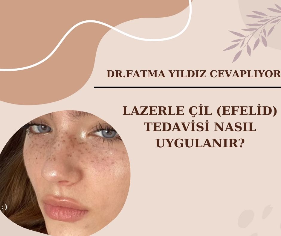 Lazerle/ Çil (Efelid)/ Tedavisi /Nasıl Uygulanır?