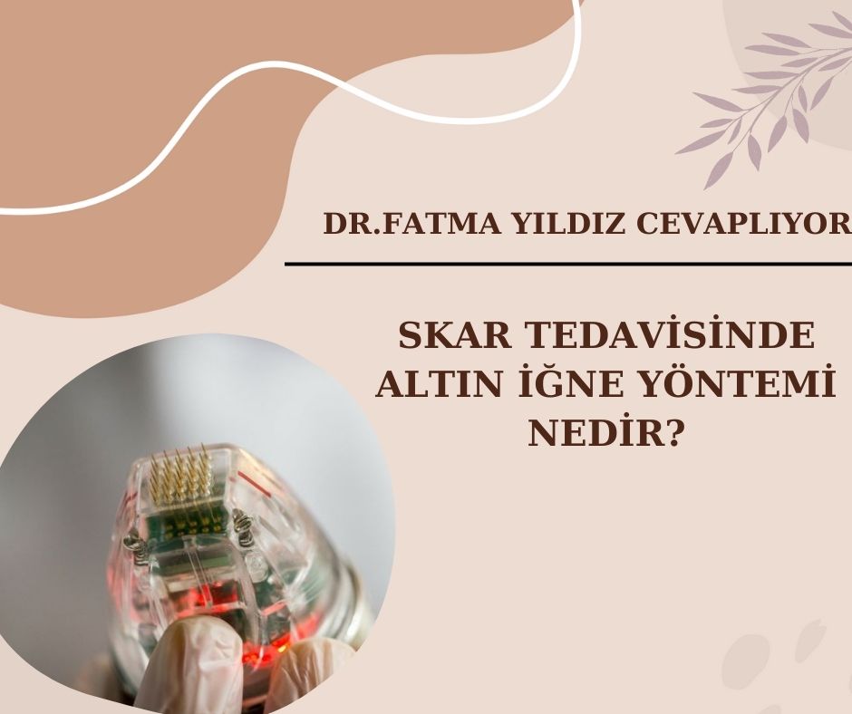 Skar Tedavisinde /Altın İğne Yöntemi/ Nedir?