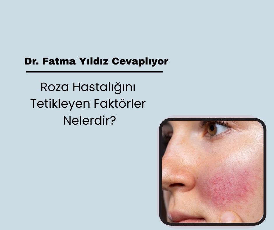 Roza Hastalığını Tetikleyen Faktörler Nelerdir?