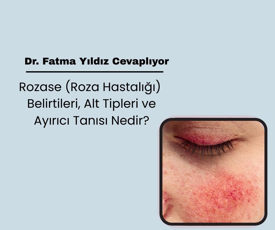 Rozase (Roza Hastalığı) Belirtileri, Alt Tipleri ve Ayırıcı Tanısı Nedir?