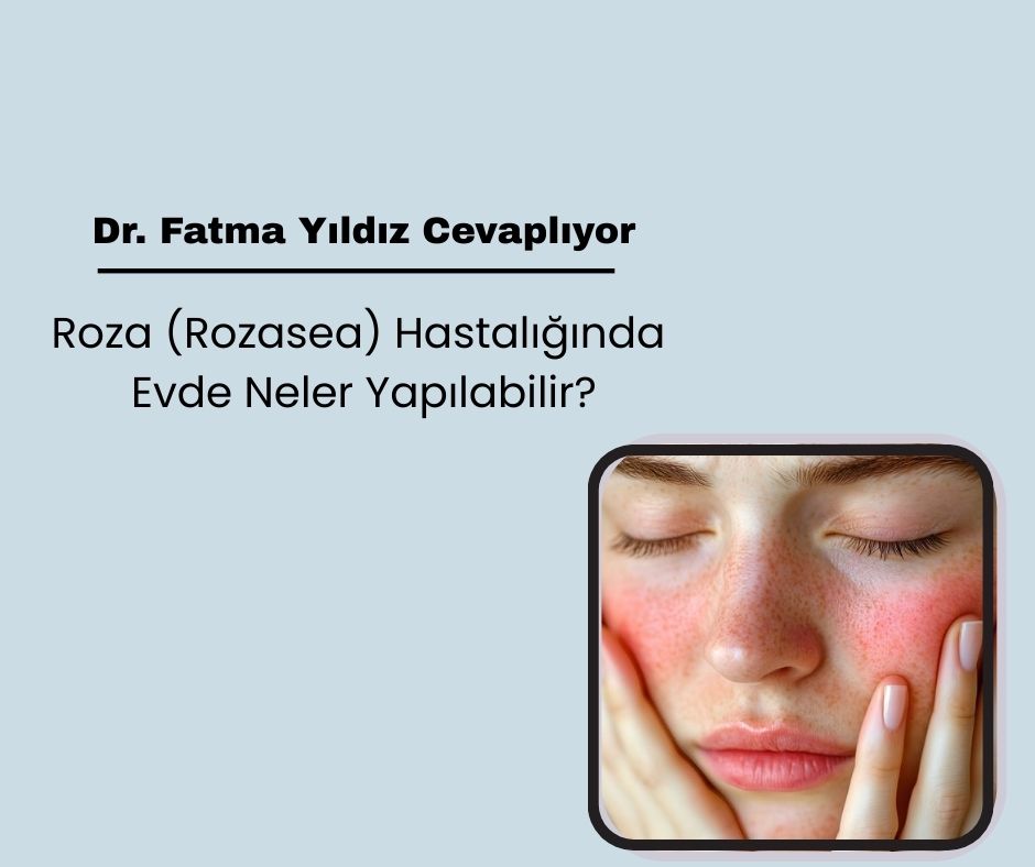 Roza (Rozasea) Hastalığında Evde Neler Yapılabilir?