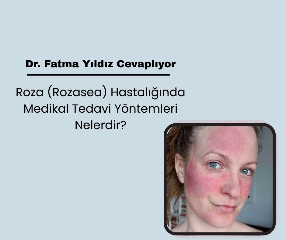 Roza (Rozasea) Hastalığında Medikal Tedavi Yöntemleri Nelerdir?