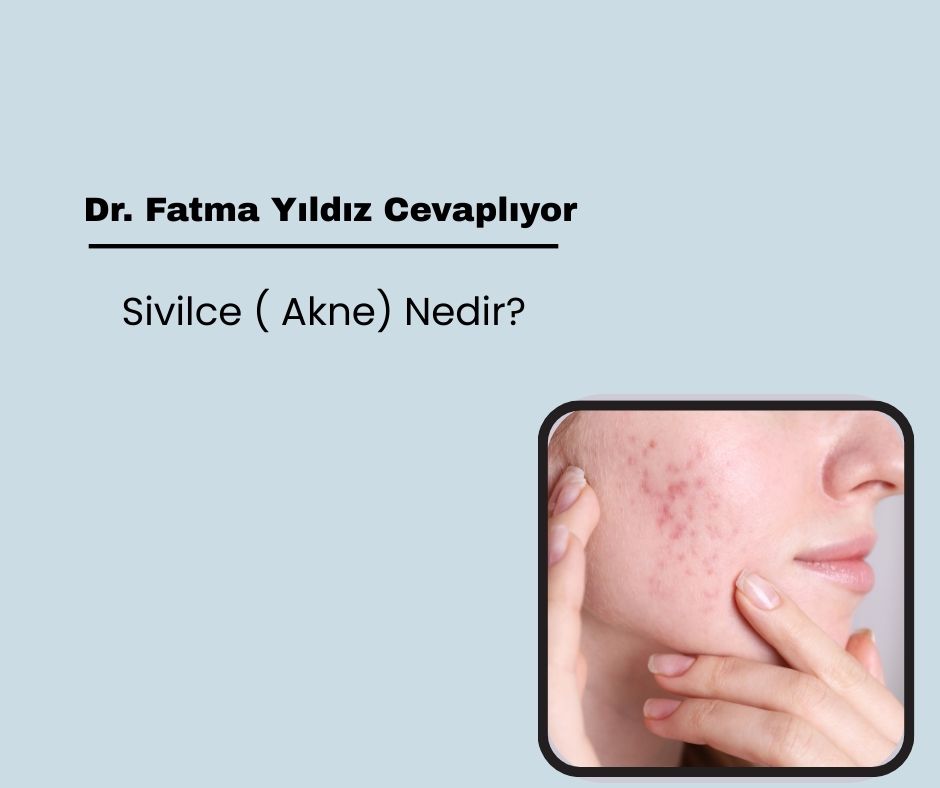 Sivilce ( Akne) Nedir?