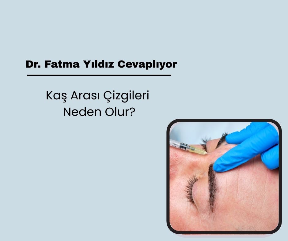Kaş arası çizgileri neden olur?