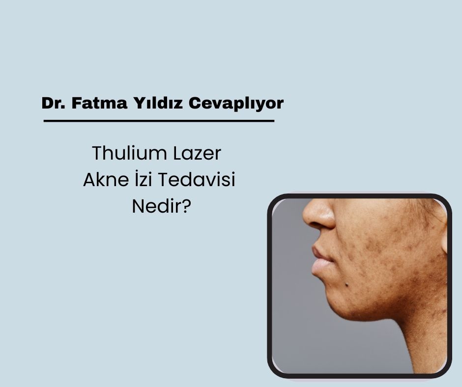 Thulium lazer akne izi tedavisi nedir?