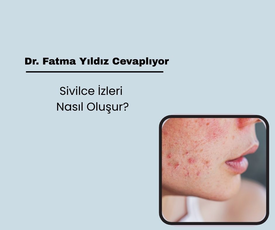 Sivilce izleri nasıl oluşur?