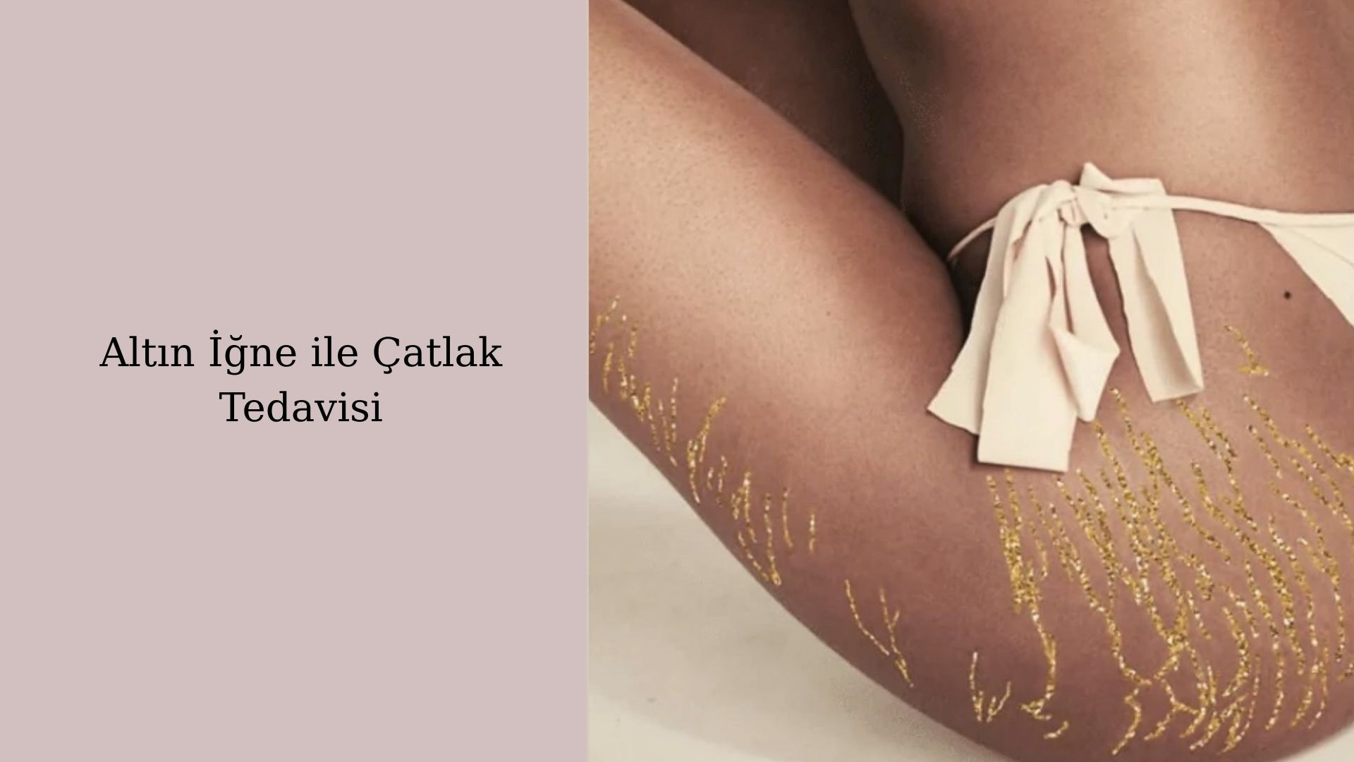 ankara altin igne catlak tedavisi