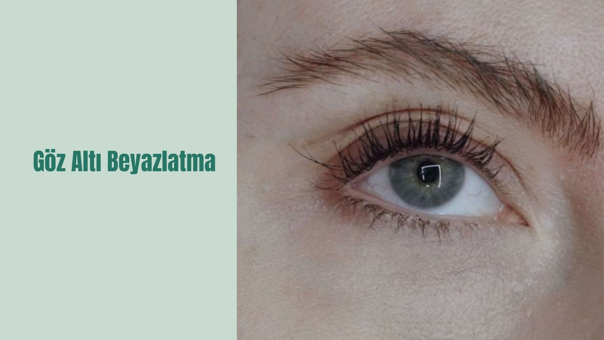 ankara goz alti beyazlatma