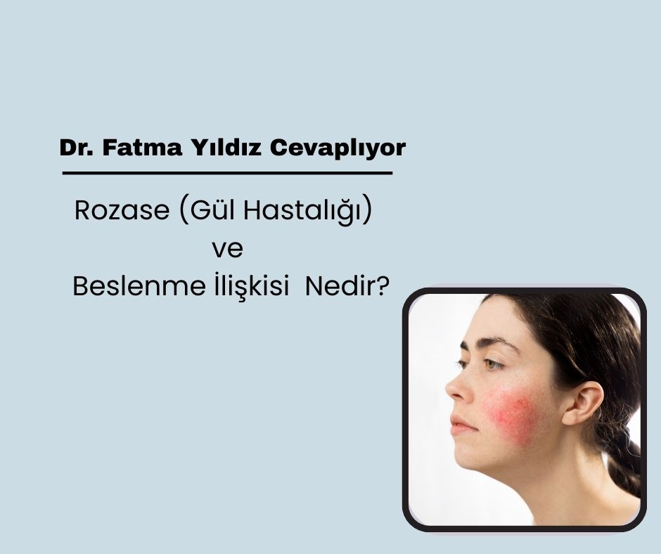 Rozase (Gül Hastalığı) ve Beslenme İlişkisi  Nedir?