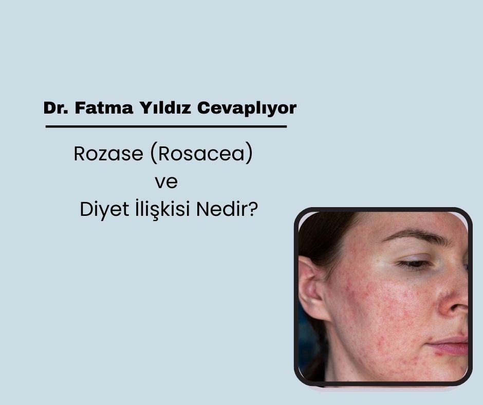 Rozase (Rosacea) ve Diyet İlişkisi Nedir?