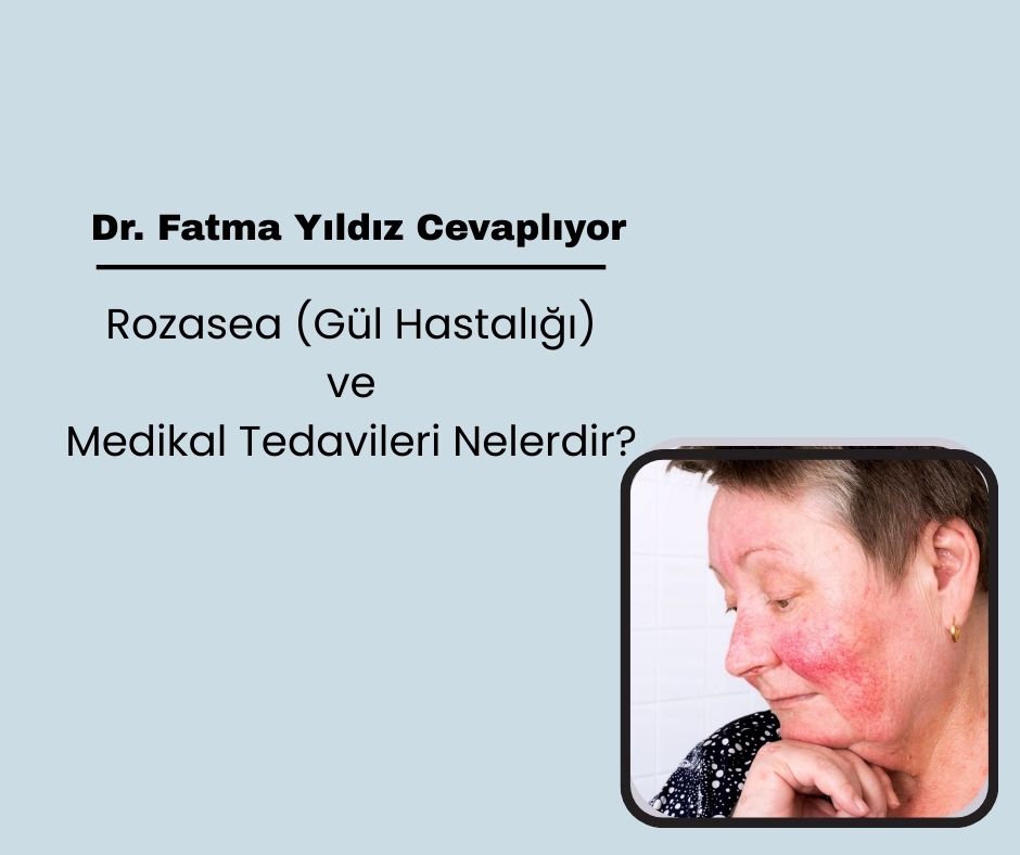 Rozasea (Gül Hastalığı) ve Medikal Tedaviler