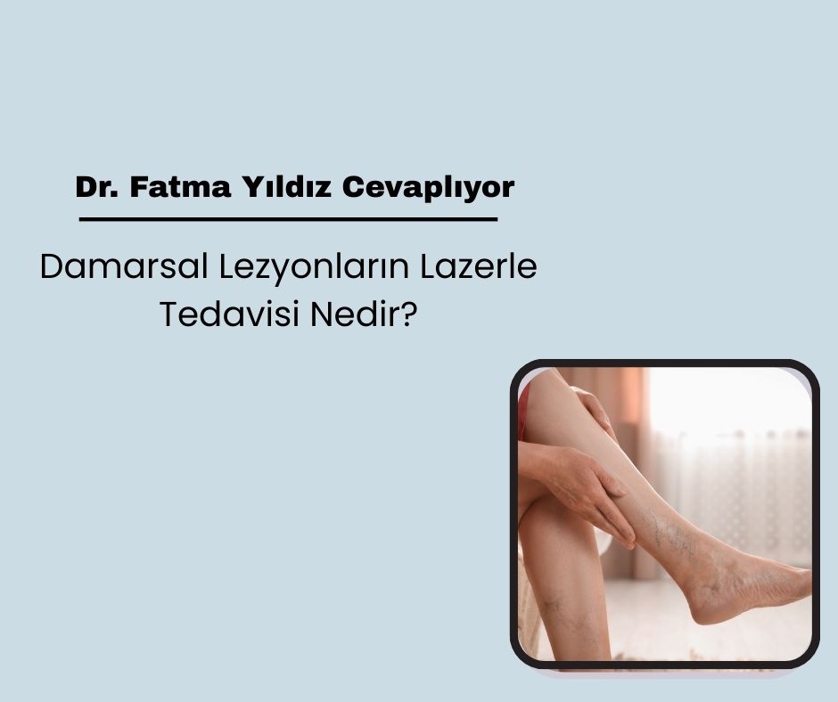 Damarsal Lezyonların Lazerle Tedavisi Nedir?