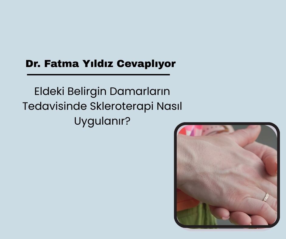 Eldeki Belirgin Damarların Tedavisinde Skleroterapi Nasıl Uygulanır?