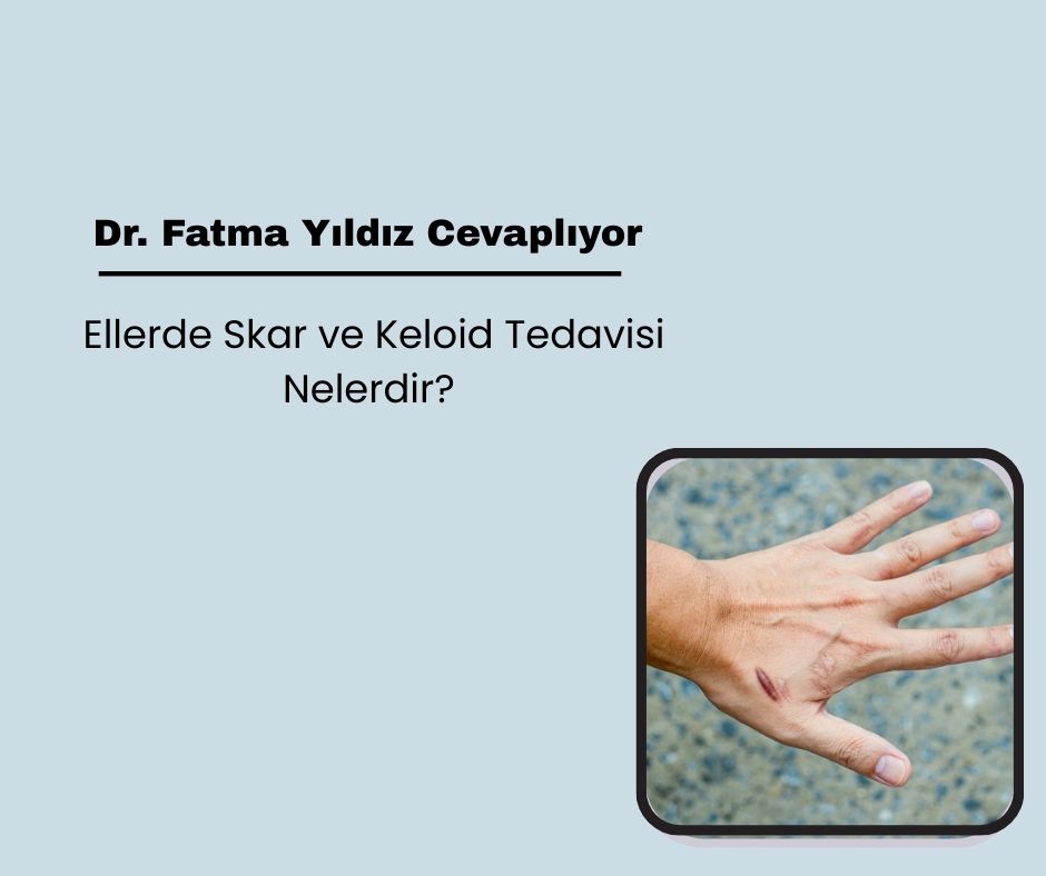 Ellerde Skar ve Keloid Tedavisi Nelerdir?