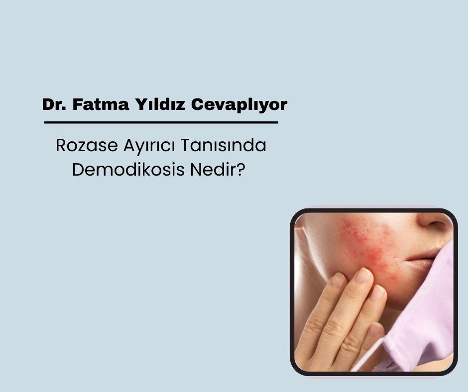 Rozase Ayırıcı Tanısında Demodikosis Nedir?