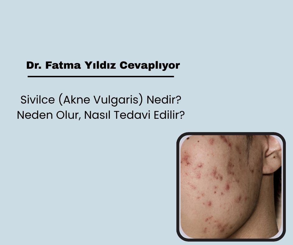 Sivilce (Akne Vulgaris) Nedir? Neden Olur, Nasıl Tedavi Edilir?