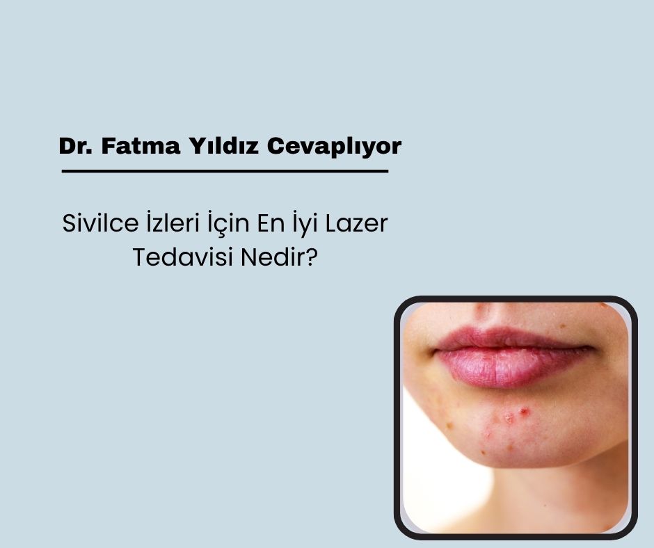 Sivilce İzleri İçin En İyi Lazer Tedavisi Nedir?