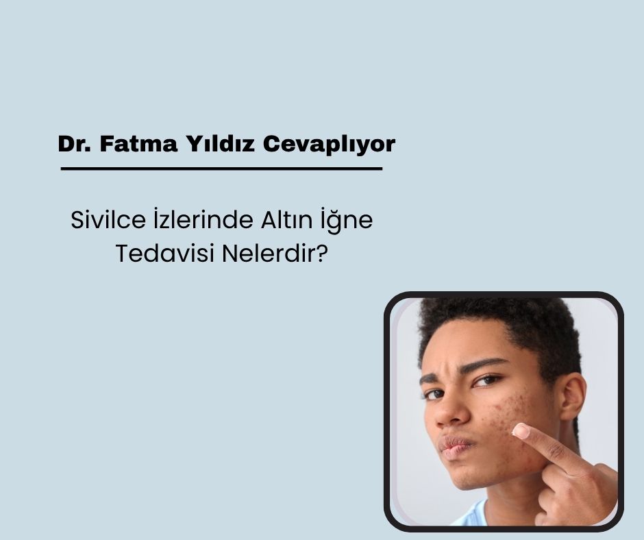 Sivilce İzlerinde Altın İğne Tedavisi Nelerdir?