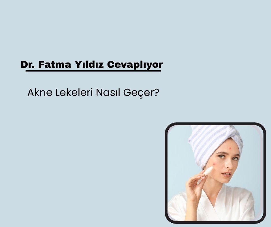 Akne Lekeleri Nasıl Geçer?