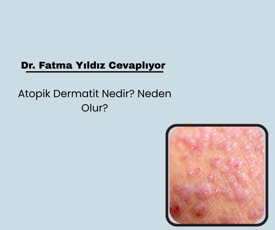 Atopik Dermatit Nedir? Neden Olur?