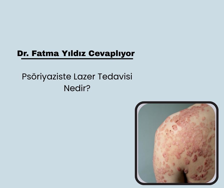 Psöriyaziste Lazer Tedavisi Nedir?