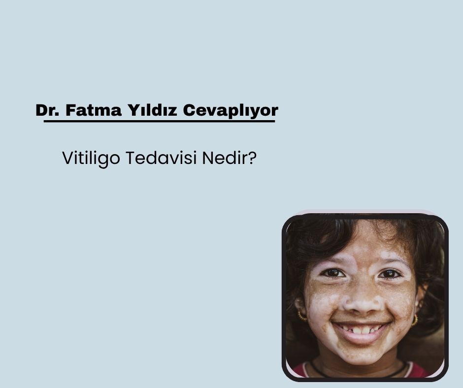Vitiligo Tedavisi Nedir?