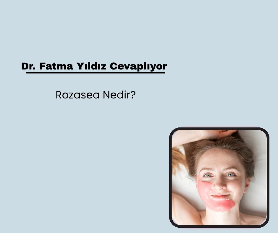 Rozasea Nedir?