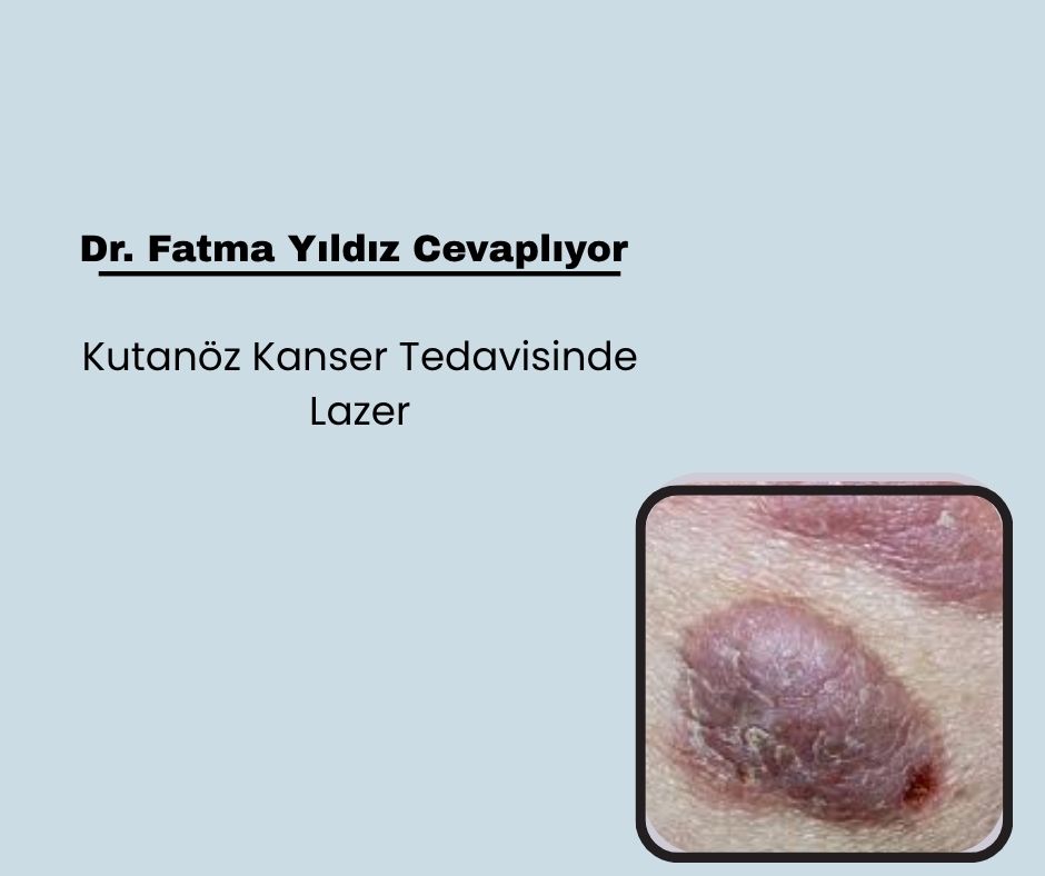 Kutanöz Kanser Tedavisinde Lazer