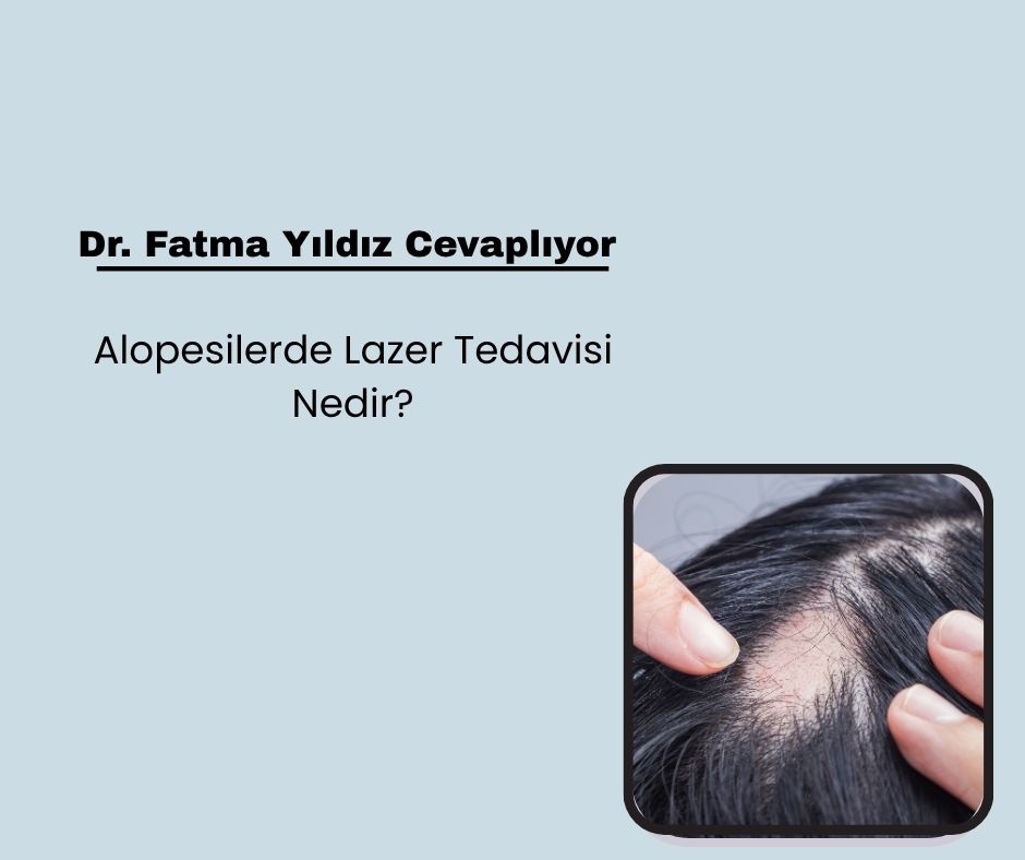 Alopesilerde Lazer Tedavisi Nedir?