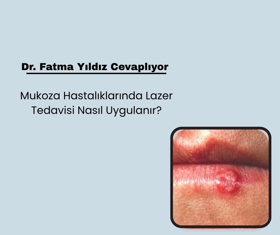 Mukoza Hastalıklarında Lazer Tedavisi Nasıl Uygulanır?