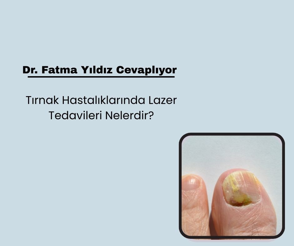 Tırnak Hastalıklarında Lazer Tedavisi