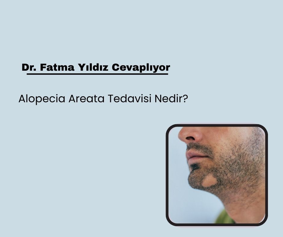 Alopecia Areata Tedavisi Nedir?