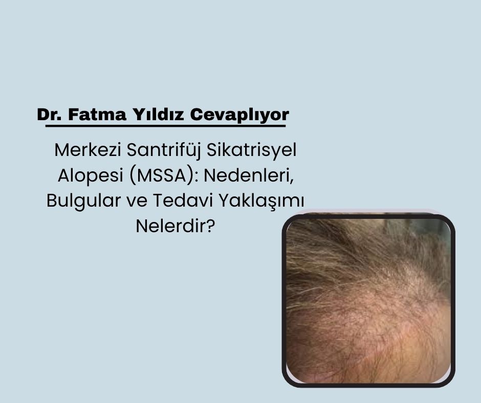 Merkezi Santrifüj Sikatrisyel Alopesi (MSSA): Nedenleri, Bulgular ve Tedavi Yaklaşımı