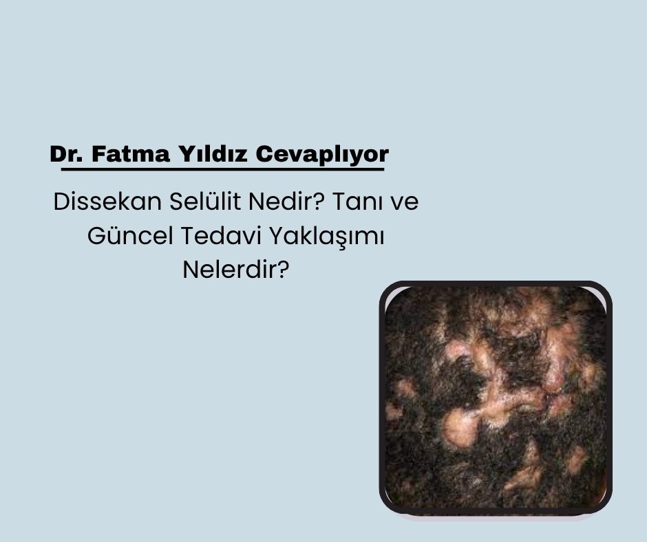 Dissekan Selülit Nedir? Tanı ve Güncel Tedavi Yaklaşımı Nelerdir