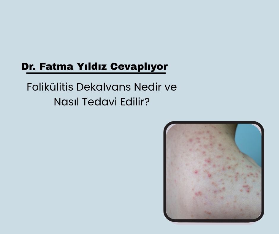 Folikülitis Dekalvans Nedir ve Nasıl Tedavi Edilir?