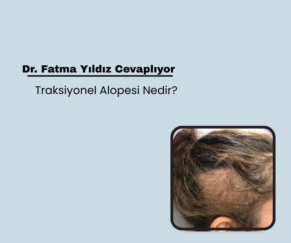 Traksiyonel Alopesi Nedir?
