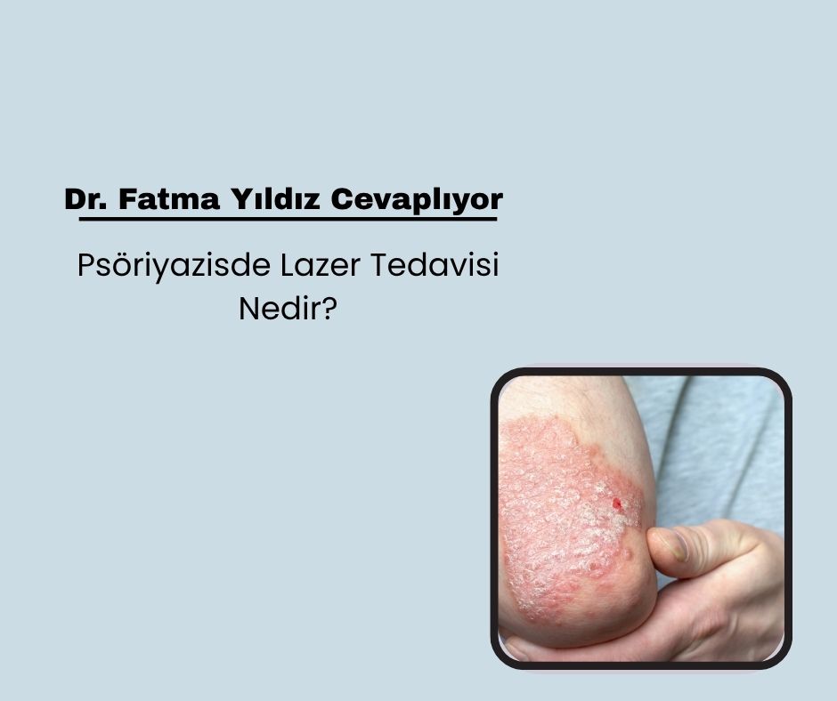 Psöriyazisde Lazer Tedavisi Nedir?