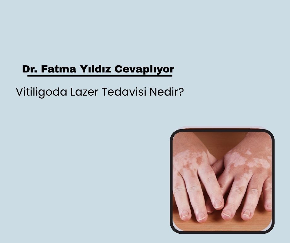 Vitiligoda Lazer Tedavisi Nedir?