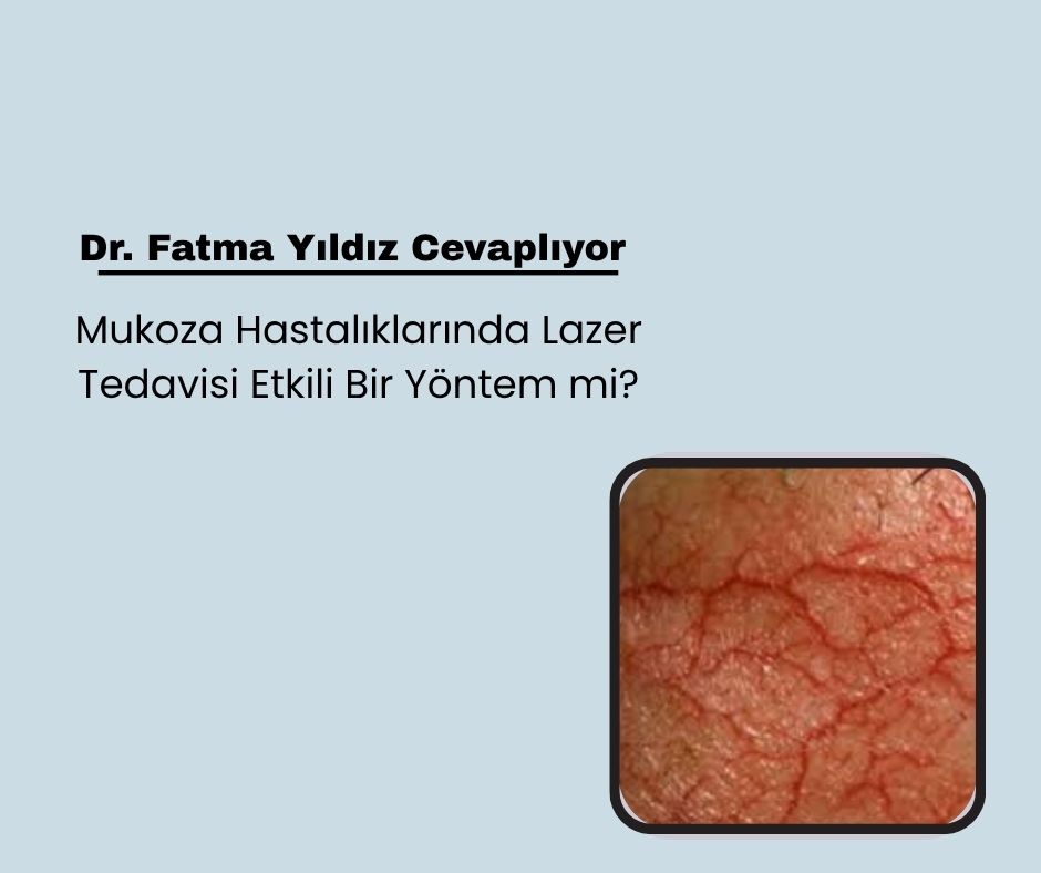 Mukoza Hastalıklarında Lazer Tedavisi Etkili Bir Yöntem mi?
