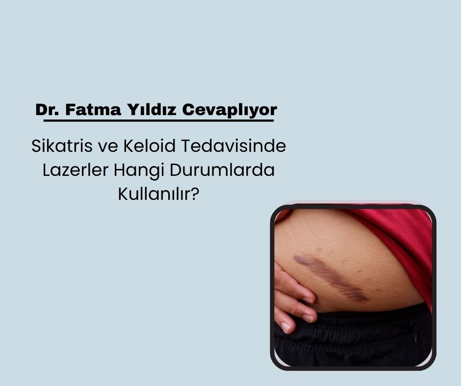 Sikatris ve Keloid Tedavisinde Lazerler Hangi Durumlarda Kullanılır?