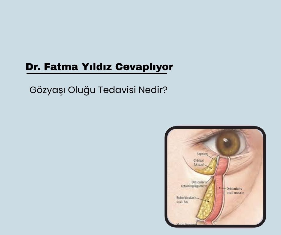 Gözyaşı Oluğu Tedavisi Nedir?