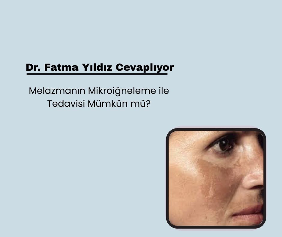 Melazmanın Mikroiğneleme ile Tedavisi Mümkün mü?