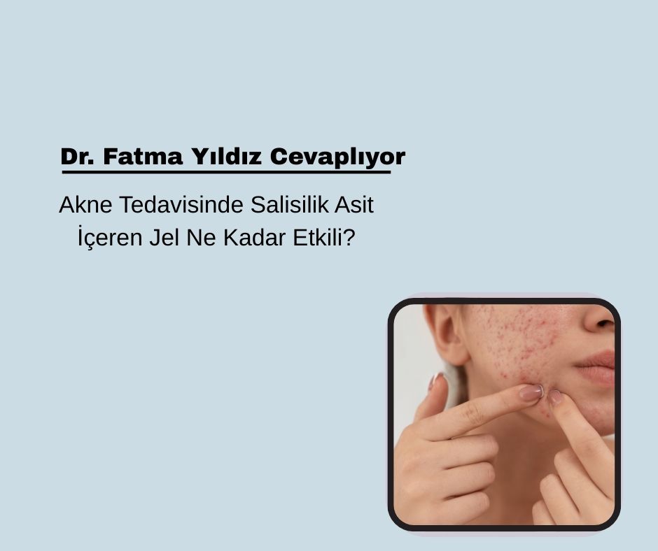 Akne Tedavisinde Salisilik Asit İçeren Jel Ne Kadar Etkili?
